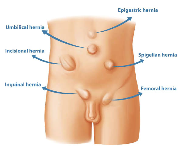 Diagram of female lower abdomen showing various types of hernias labeled, including umbilical, incisional, inguinal, epigastric, spigelian, and femoral hernias.
