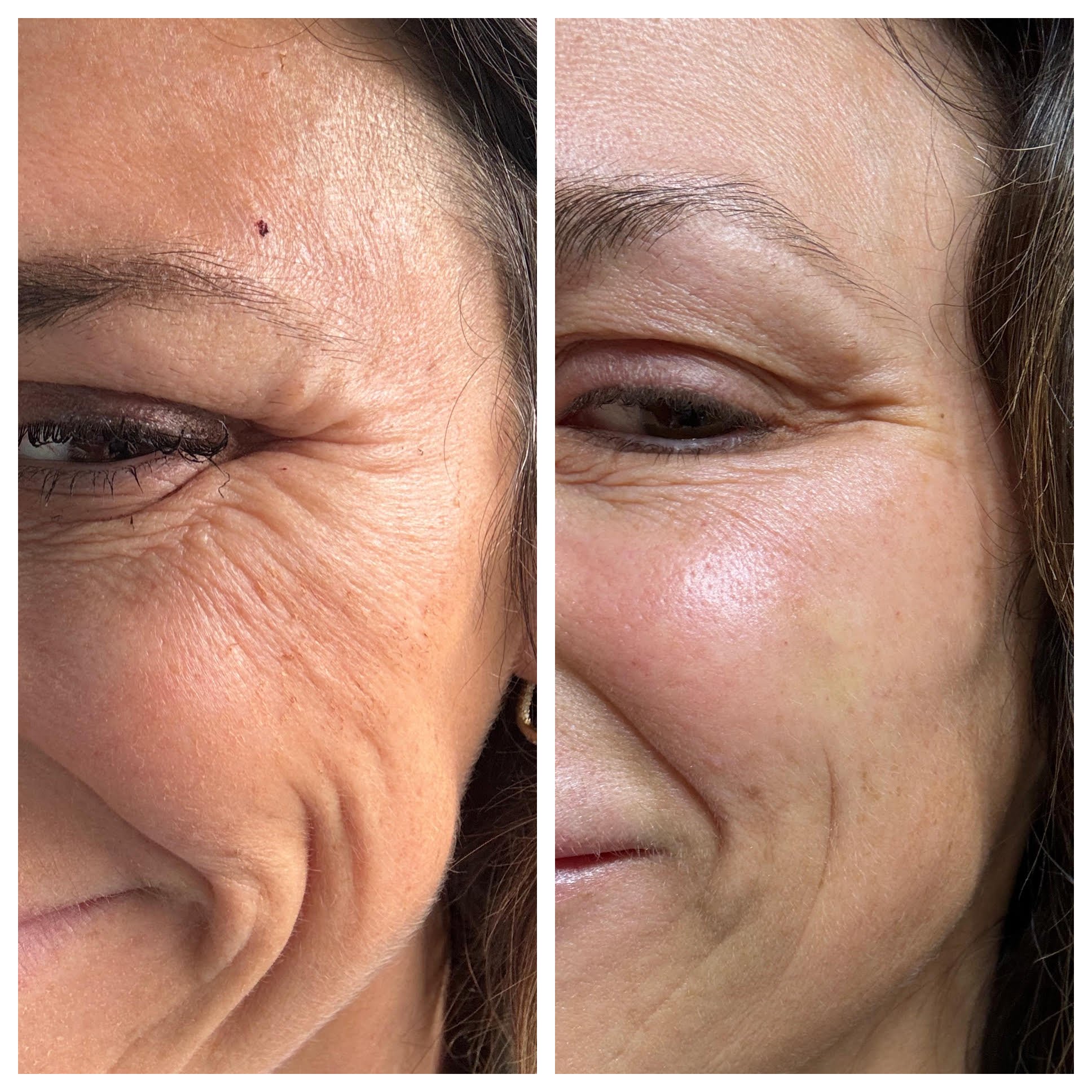 Tox in Wayne, PA 19087 | Avenue Beauty Science