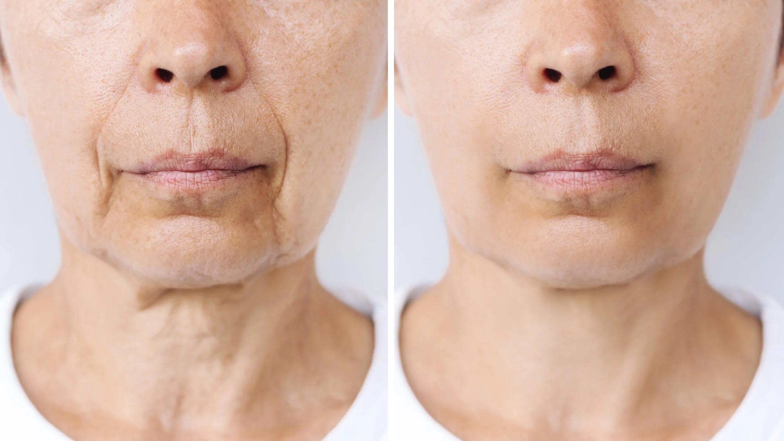 Fillers in Wayne, PA 19087 | Avenue Beauty Science