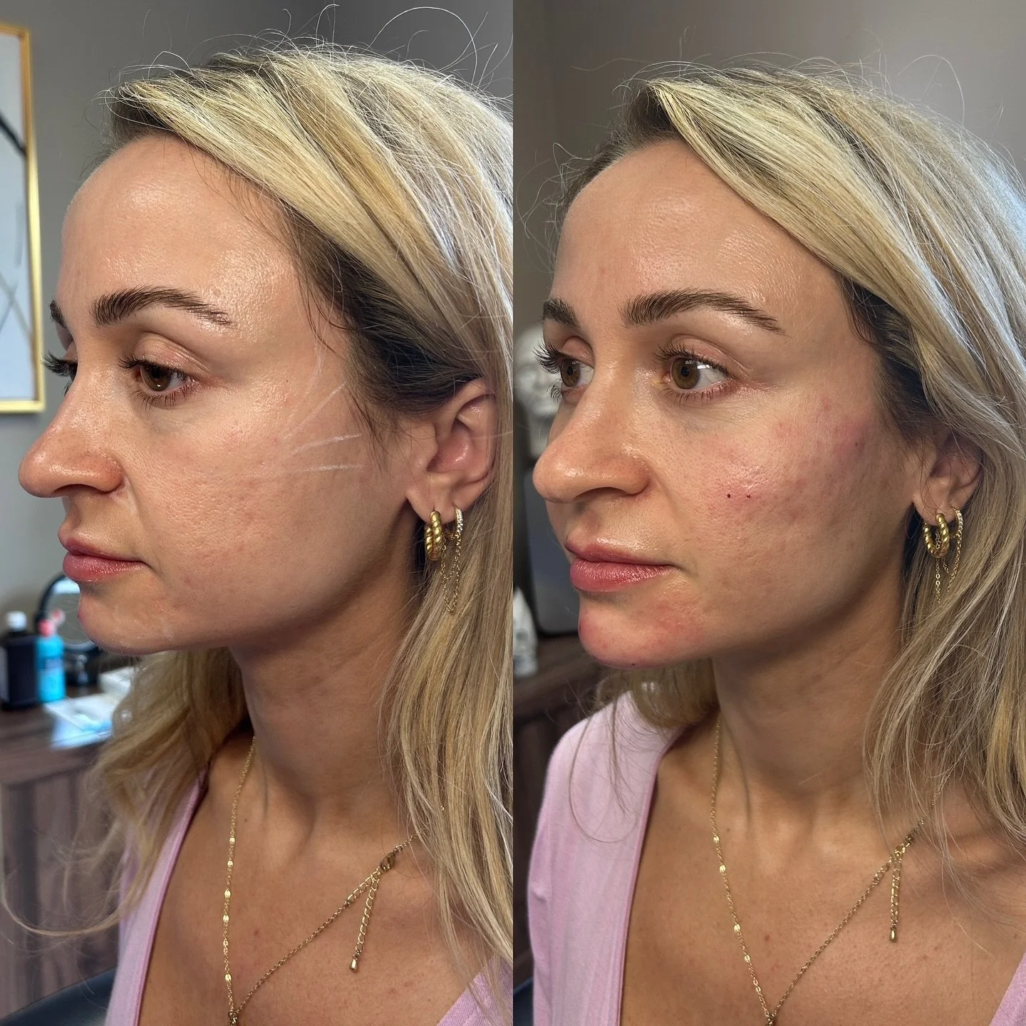✨ Facial balancing isn&rsquo;t about changing who you are &mdash; it&rsquo;s about highlighting your natural beauty and creating harmony in your features. At Sorella Aesthetics, we specialize in subtle, natural results that leave you looking refreshe