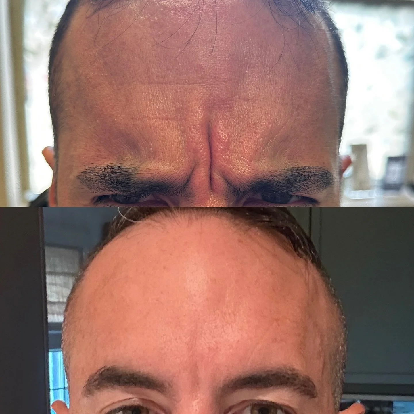 It&rsquo;s never too late for botox! Look at how it decreased  the lines all throughout the forehead. Plus remember aesthetics isn&rsquo;t just for women!! It&rsquo;s for anyone 🥰😘

#botox #filler #microneedling #jeuveau #laser #rha #evolus #dyspor