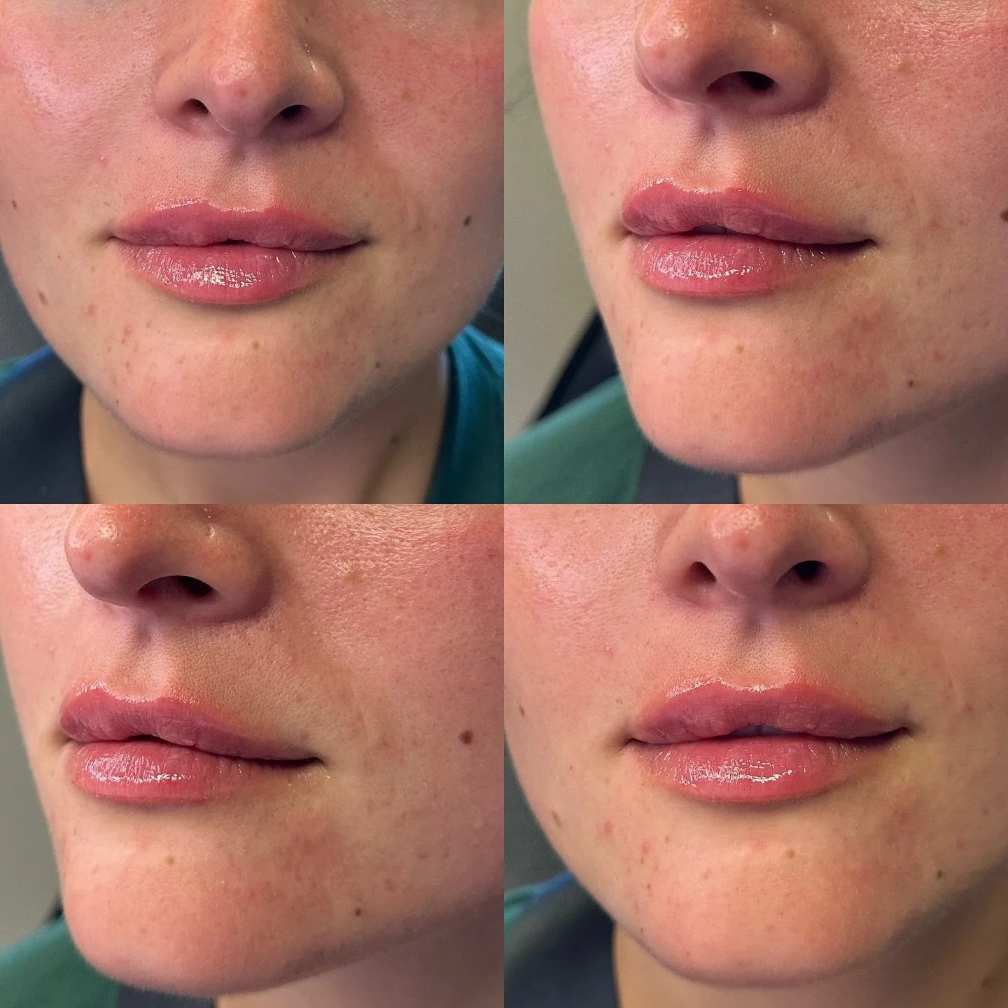 💋 Lips that look soft, natural, and perfectly you. At Sorella Aesthetics, we focus on enhancing your shape and balance &mdash; not overdoing it. Whether you&rsquo;re looking for a subtle refresh or more volume, we&rsquo;ll create results that fit yo