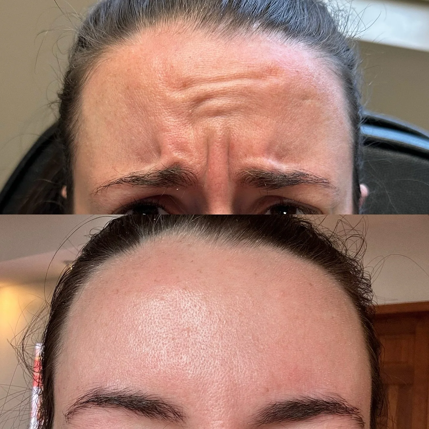 Glassy, glowy, smooth 🤩

#botox #filler #microneedling #jeuveau #laser #rha #evolus #dysport #juvederm #restylane #perfectdermapeel #penfield #versa #sculptra #beforeandafter #lipinjections #prp #aesthetics #medspa #neurotoxin #webster #lipflip #kyb