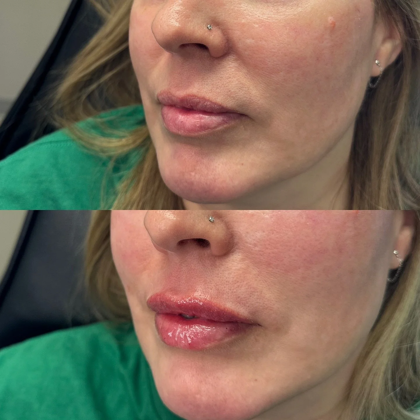💉 Enhanced, not overdone. Our expert lip filler treatments are designed to create natural-looking volume, definition, and balance &ndash; tailored just for you. 💋✨

Whether you&rsquo;re going for subtle or for a statement, we can help you achieve y