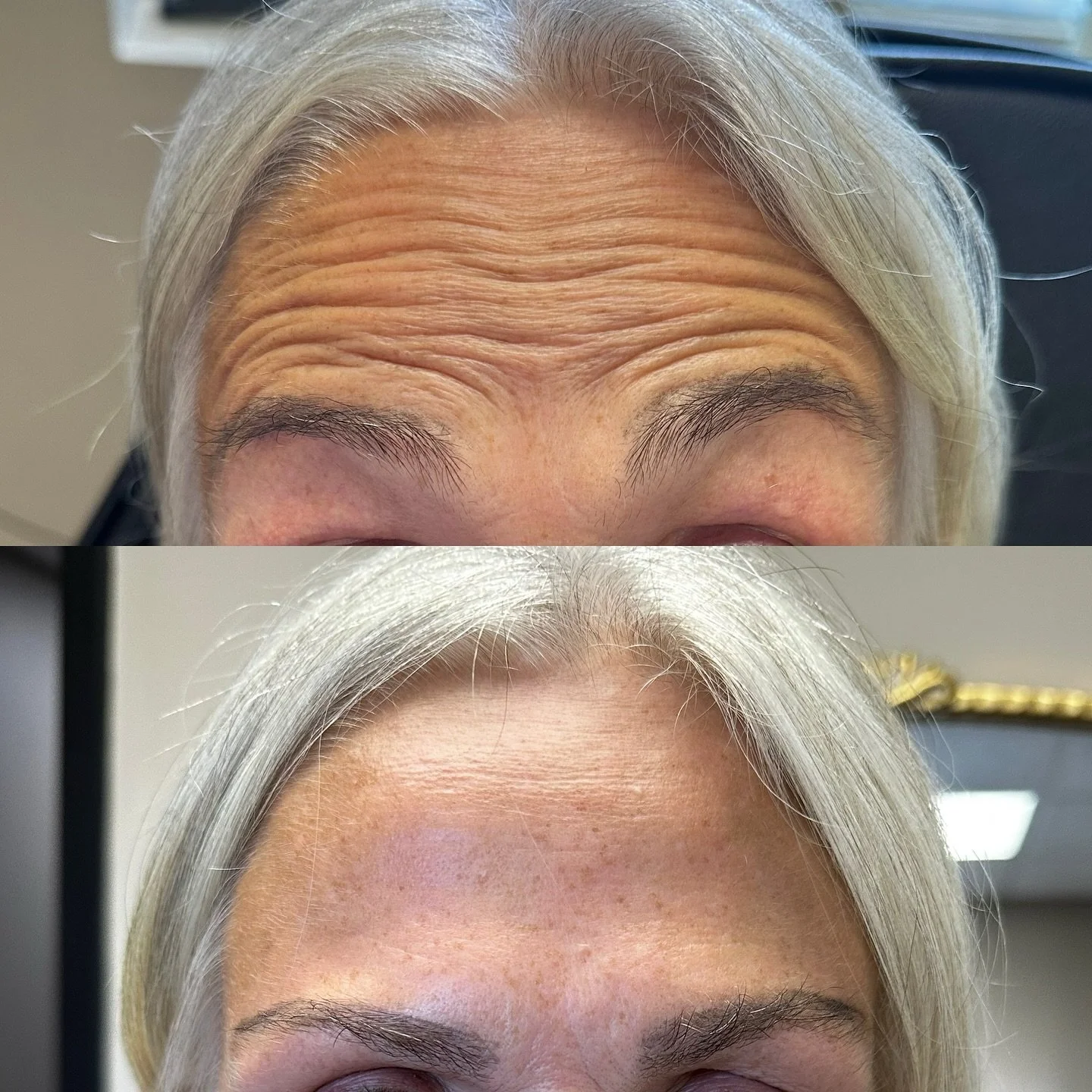 ✨ Smooth, refreshed, and confidently you. Botox isn&rsquo;t about changing your face &mdash; it&rsquo;s about softening fine lines and enhancing your natural expression. 💉

Prevent, refine, and glow with expert treatment you can trust.

📆 Book your