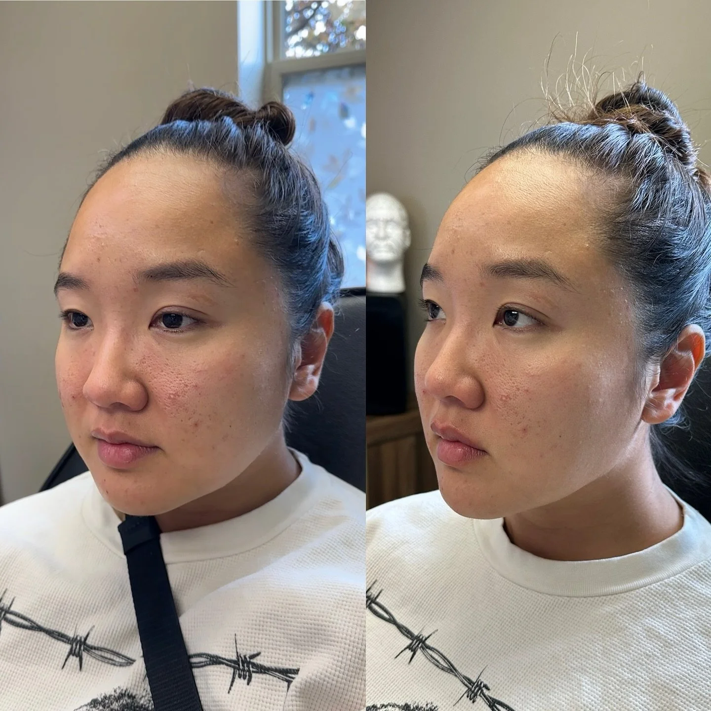 A little filler goes a long way! 👏 Chin contouring can make a world of difference &mdash; sharper, more balanced, more you!

💬 DM us to book your appointment today!
📞 585-208-9151

#ChinFiller #FacialHarmony #GlowUp #ConfidenceBoost #AestheticEnha