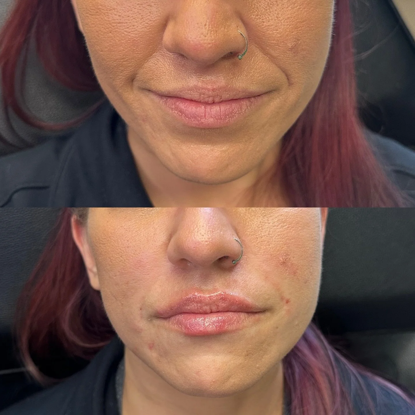 We treated her nasolabial folds slightly because she didn&rsquo;t have much cheek volume loss as well as her lips! I love how cute they turned out!

#botox #filler #microneedling #jeuveau #laser #rha #evolus #dysport #juvederm #restylane #perfectderm