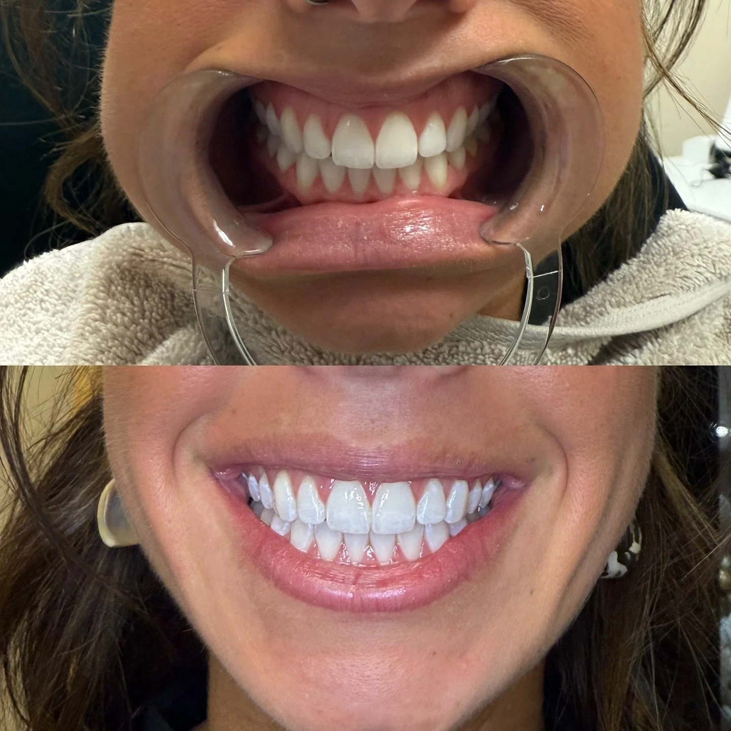 Bright beauties for the holidays! 

Book now before busy season enters! 
📞 585-208-9151

#botox #filler #microneedling #jeuveau #laser #rha #evolus #dysport #juvederm #restylane #perfectdermapeel #penfield #versa #sculptra #beforeandafter #lipinject