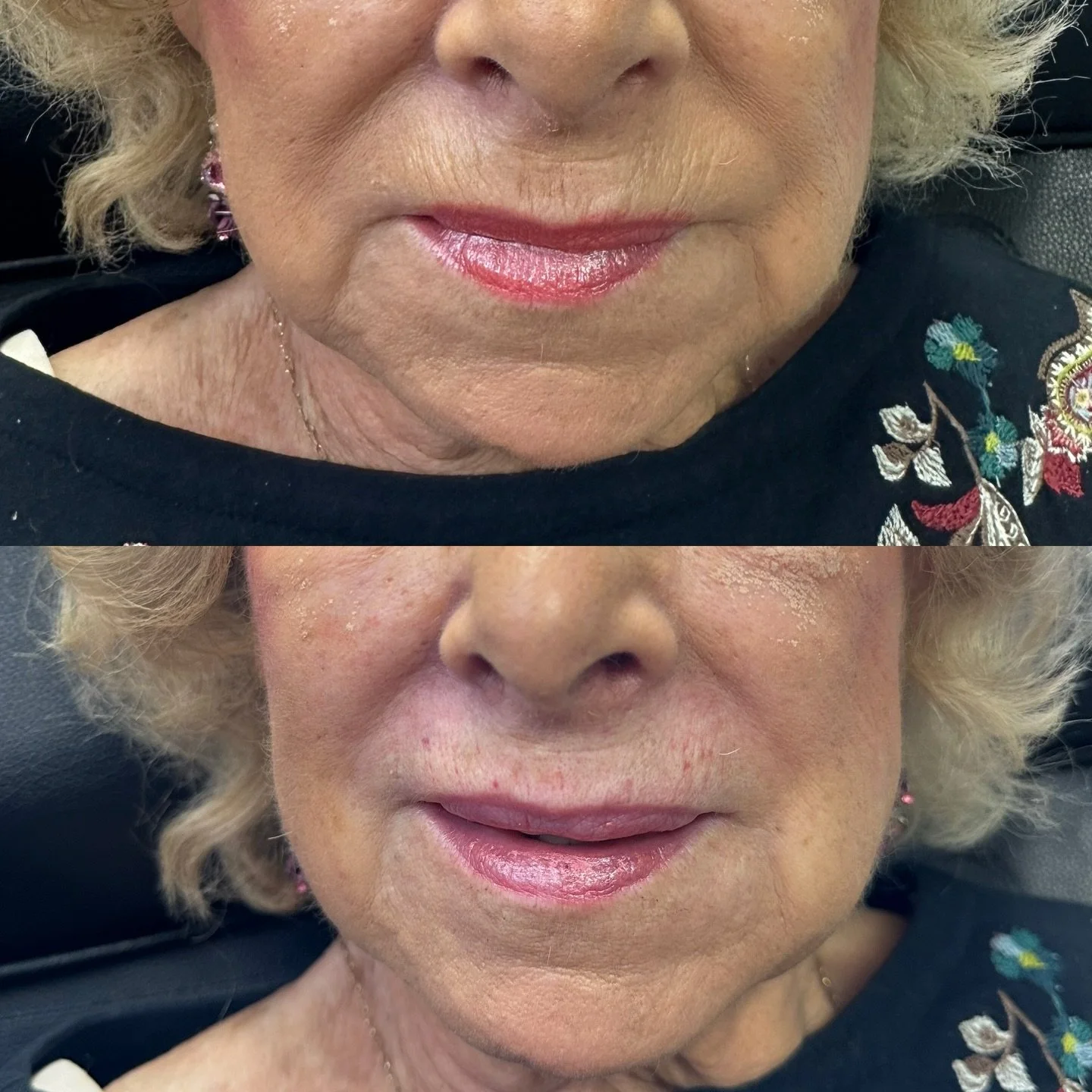 Lipstick lines GONE 🪄 

#botox #filler #microneedling #jeuveau #laser #rha #evolus #dysport #juvederm #restylane #perfectdermapeel #penfield #versa #sculptra #beforeandafter #lipinjections #prp #aesthetics #medspa #neurotoxin #webster #lipflip #kybe