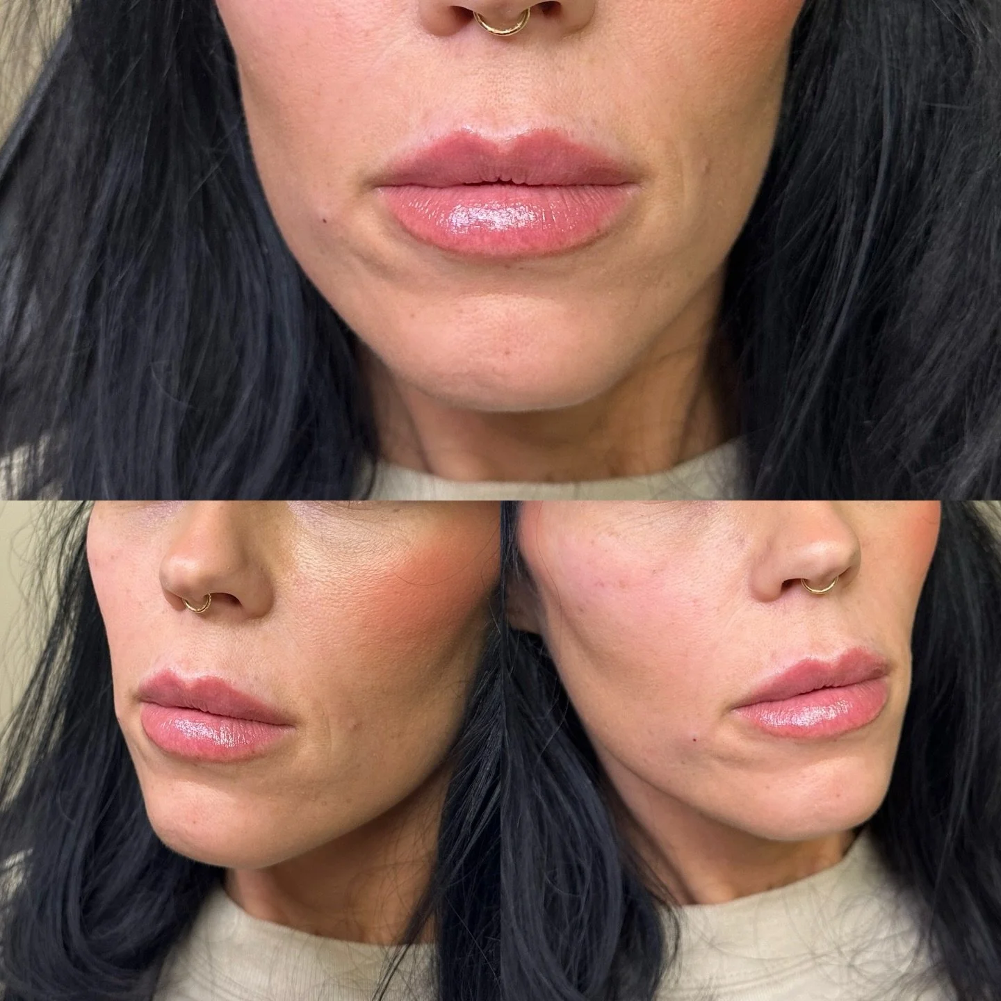 Lippie refresh 🥰😘🥰

#botox #filler #microneedling #jeuveau #laser #rha #evolus #dysport #juvederm #restylane #perfectdermapeel #penfield #versa #sculptra #beforeandafter #lipinjections #prp #aesthetics #medspa #neurotoxin #webster #lipflip #kybell