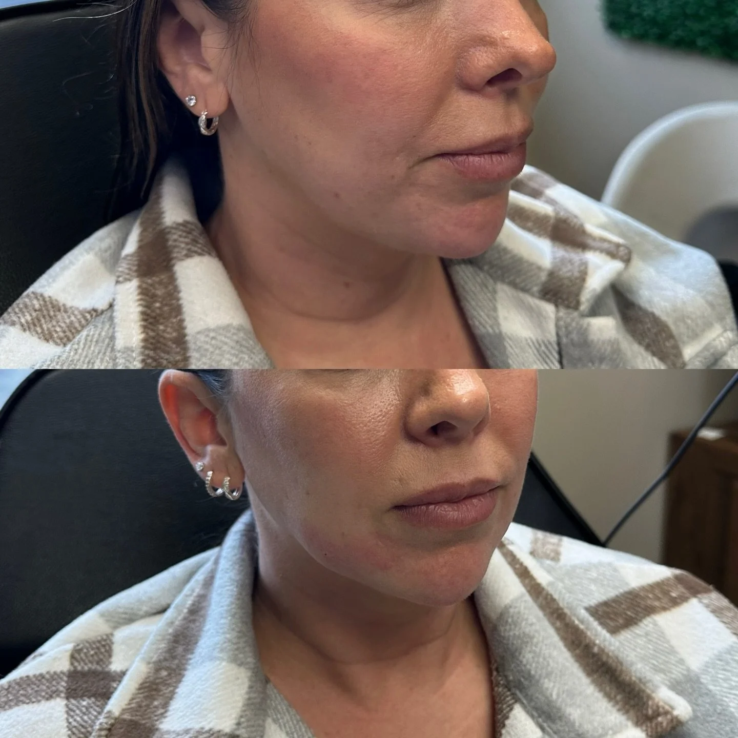 Lower face refresh 

#botox #filler #microneedling #jeuveau #laser #rha #evolus #dysport #juvederm #restylane #perfectdermapeel #penfield #versa #sculptra #beforeandafter #lipinjections #prp #aesthetics #medspa #neurotoxin #webster #lipflip #kybella 