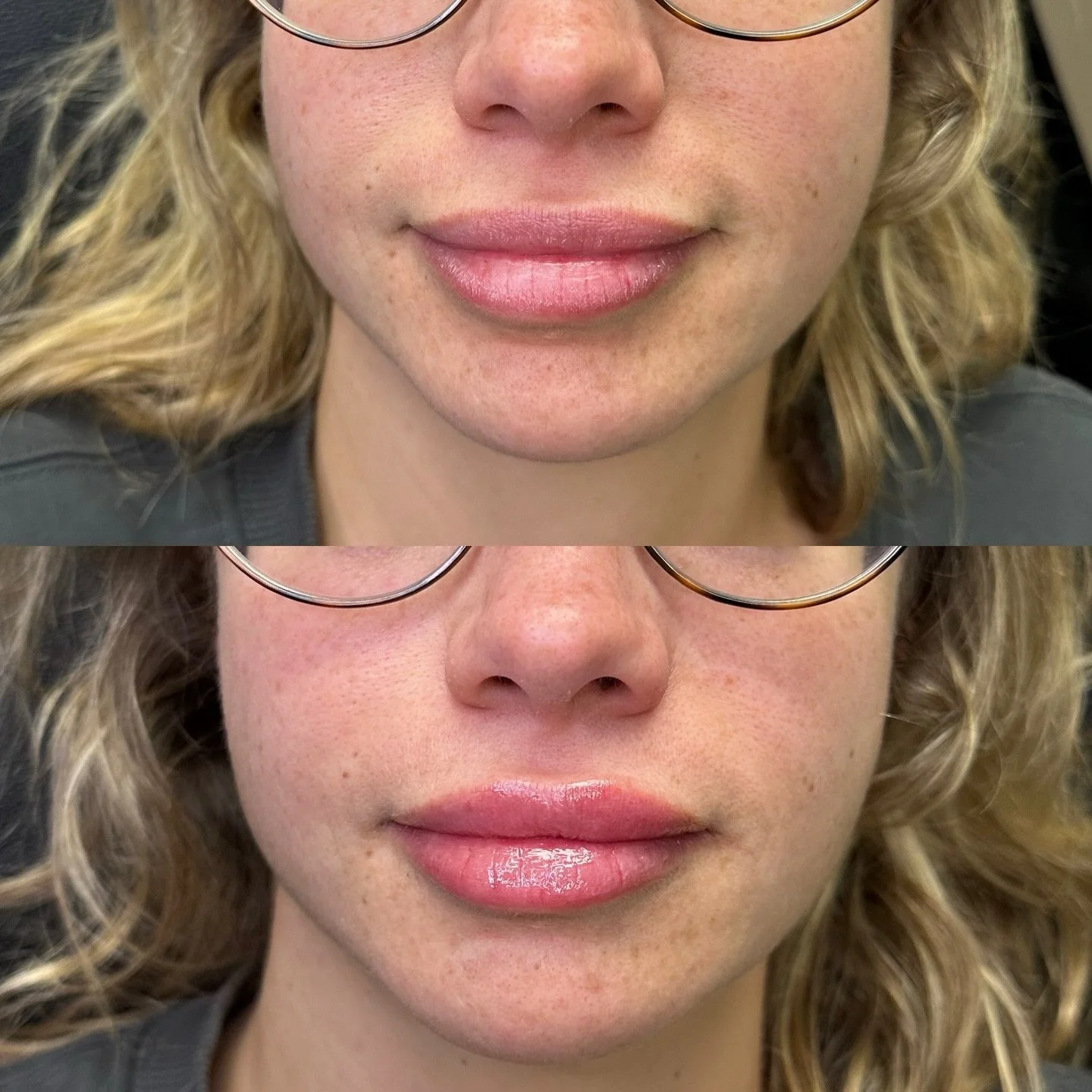 A little bit of lip definition 😍

#botox #filler #microneedling #jeuveau #laser #rha #evolus #dysport #juvederm #restylane #perfectdermapeel #penfield #versa #sculptra #beforeandafter #lipinjections #prp #aesthetics #medspa #neurotoxin #webster #lip