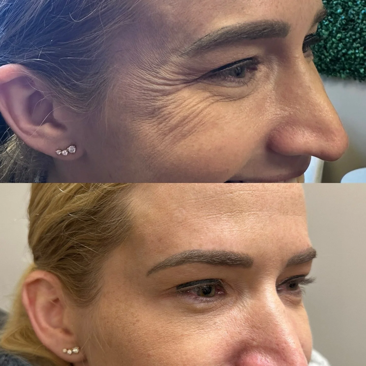 See ya later crows feet 

#botox #filler #microneedling #jeuveau #laser #rha #evolus #dysport #juvederm #restylane #perfectdermapeel #penfield #versa #sculptra #beforeandafter #lipinjections #prp #aesthetics #medspa #neurotoxin #webster #lipflip #kyb