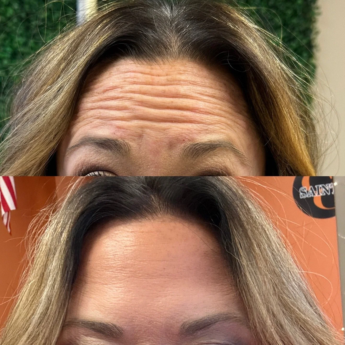 Smooth for the new year!! 

#botox #filler #medsparochester #lipfiller #rochesterny