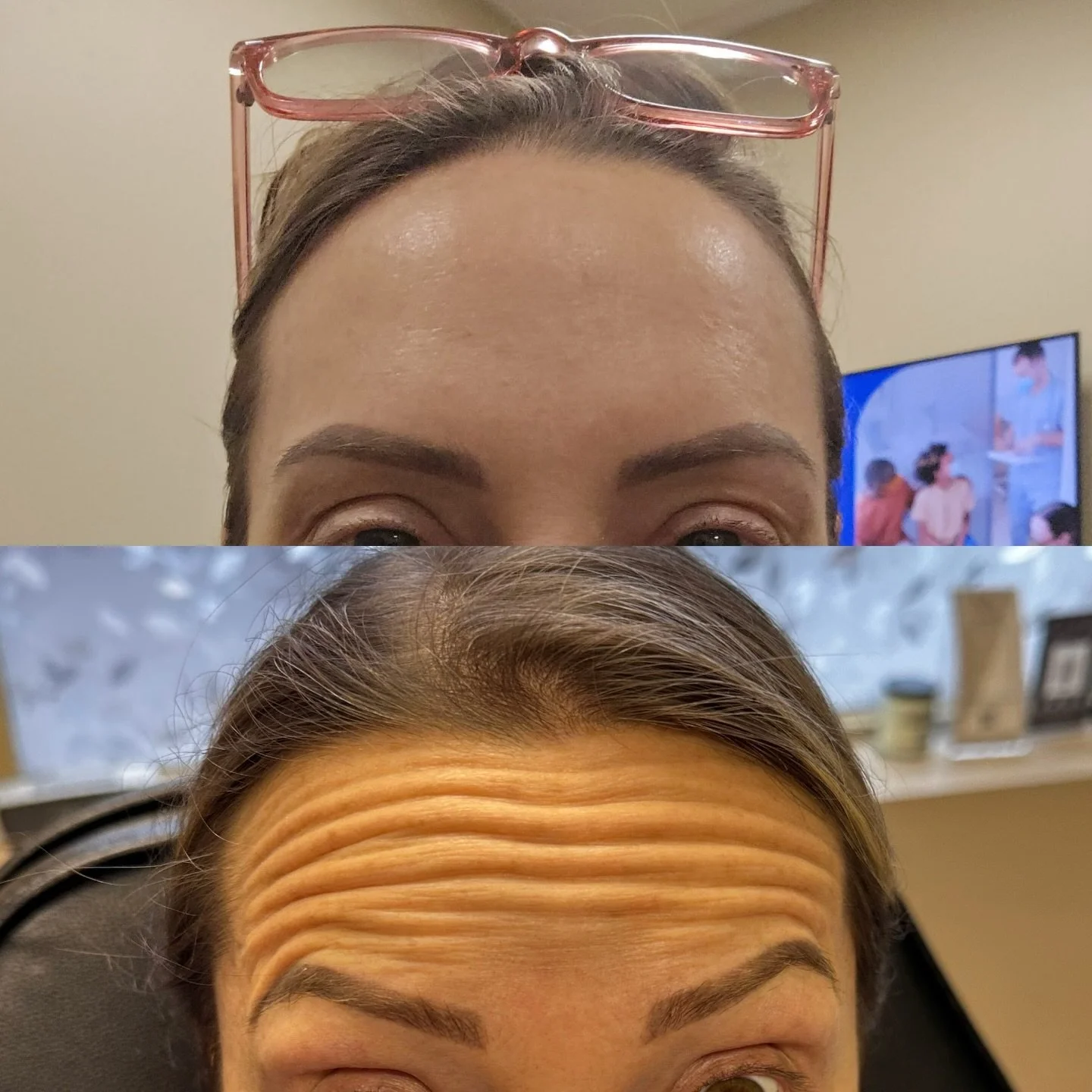 The bills win &amp; a smooth forehead 💙❤️

#botox #filler #medsparochester #lipfiller #rochesterny