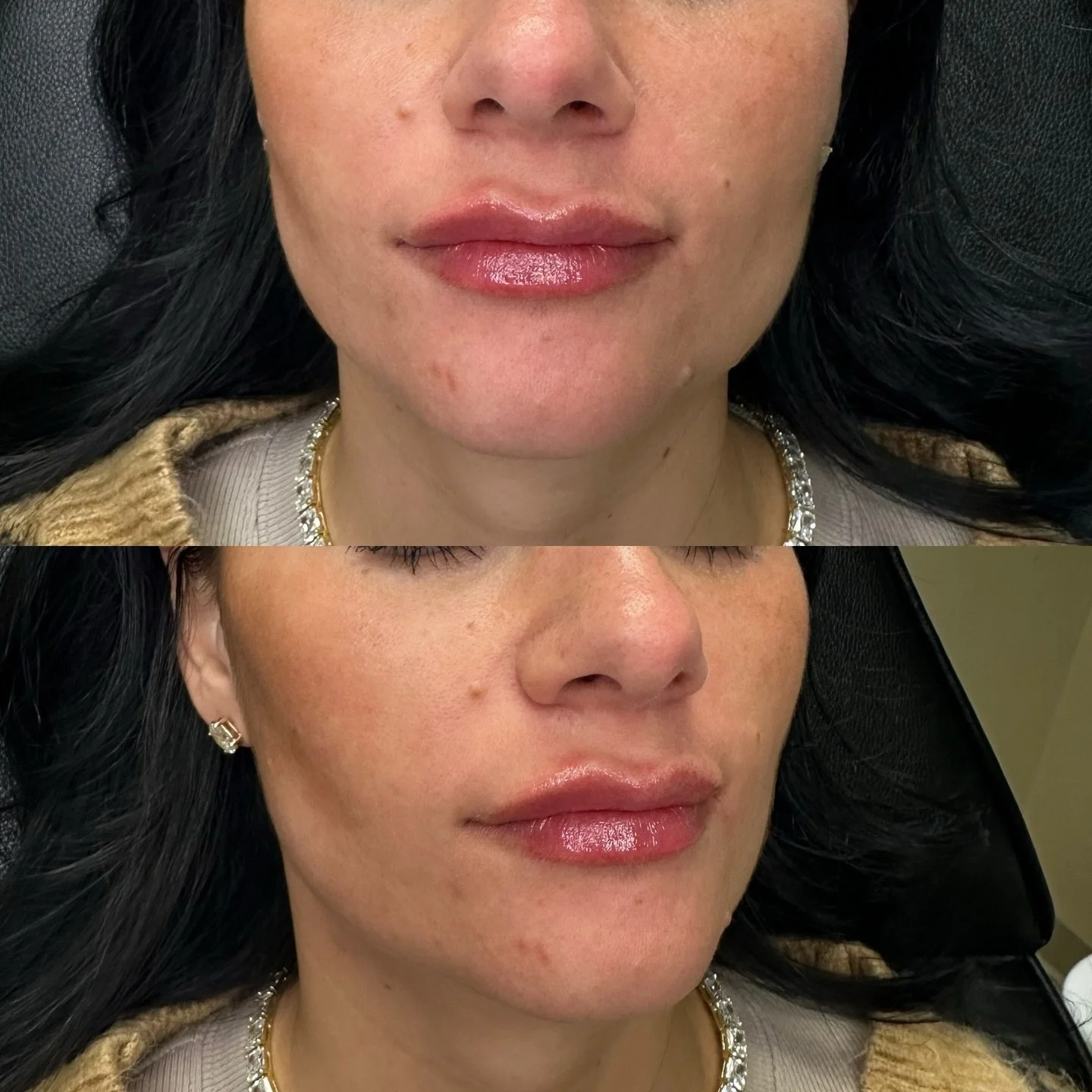 Gorgeous Shapley beauties on this chilly snow day! ❄️ ⛄️ 

#botox #filler #medsparochester #lipfiller #rochesterny