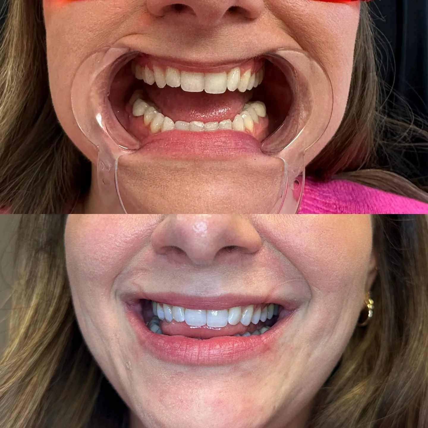 Getting ready for her big day!! 😁 💍 

#botox #filler #medsparochester #lipfiller #rochesterny