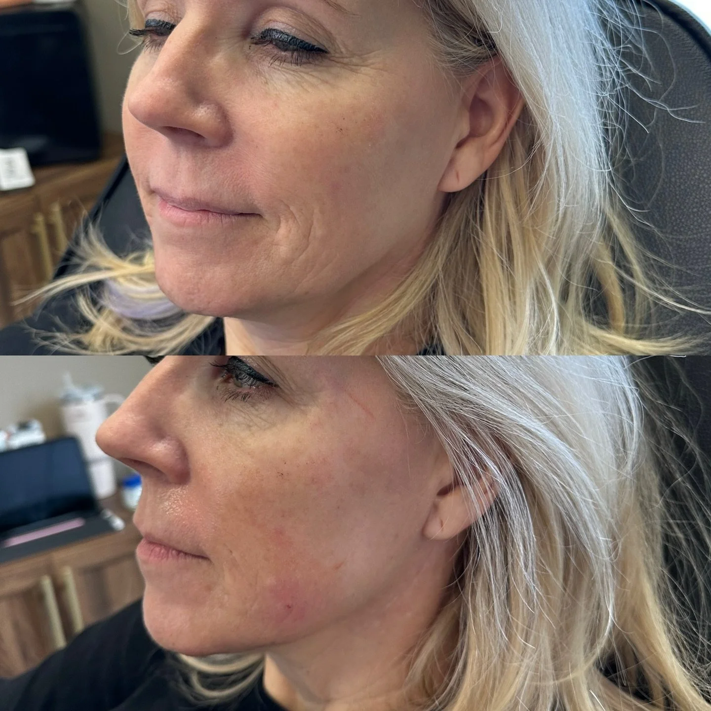 Gorgeous lower face refreshment with a few syringes 💉 

#botox #filler #medsparochester #lipfiller #rochesterny