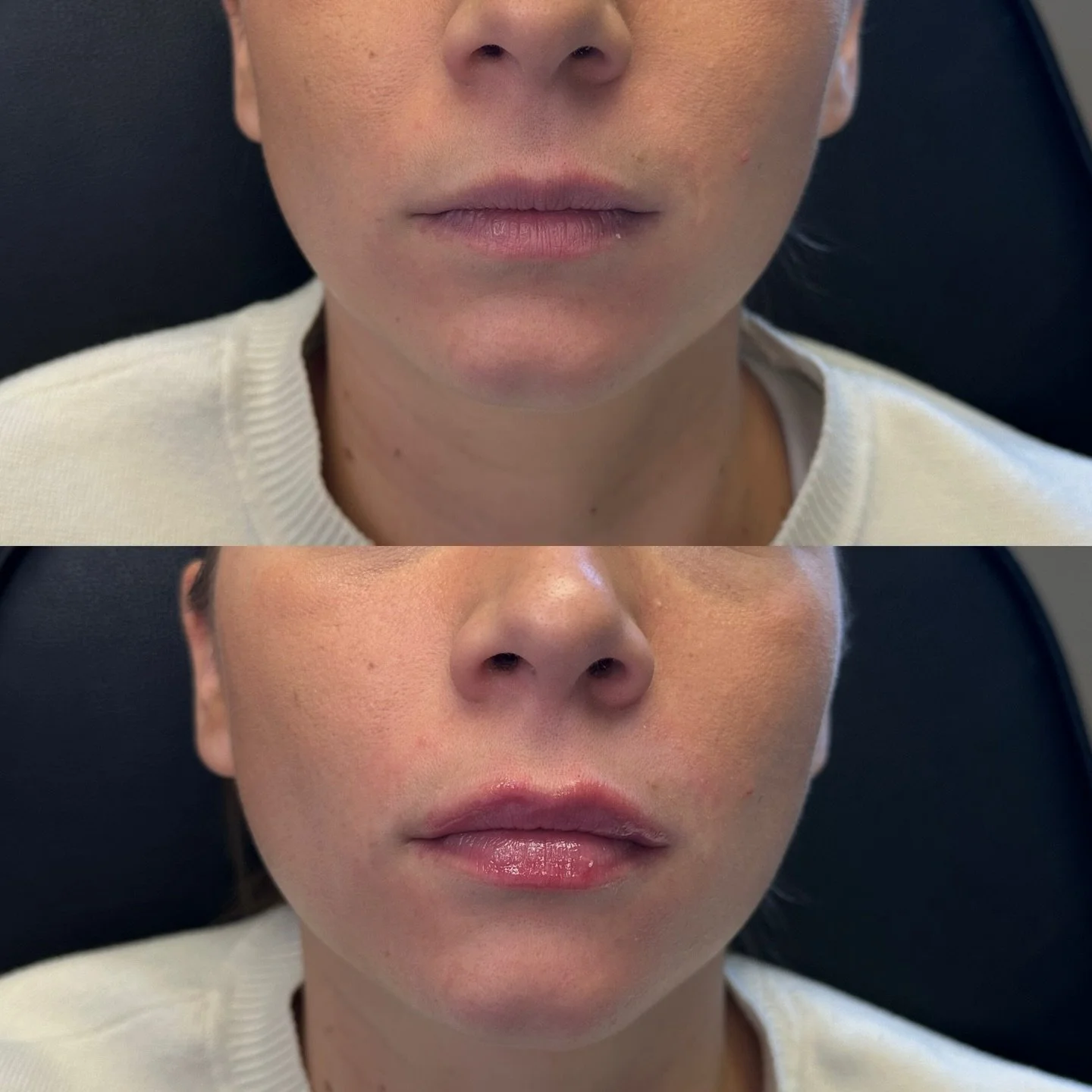 Cutie mamas 

#botox #filler #medsparochester #lipfiller #rochesterny