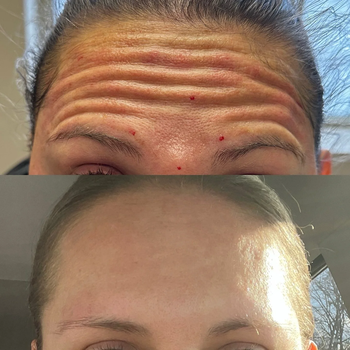 It&rsquo;s never too late for botox!!

#botox #filler #medsparochester #lipfiller #rochesterny