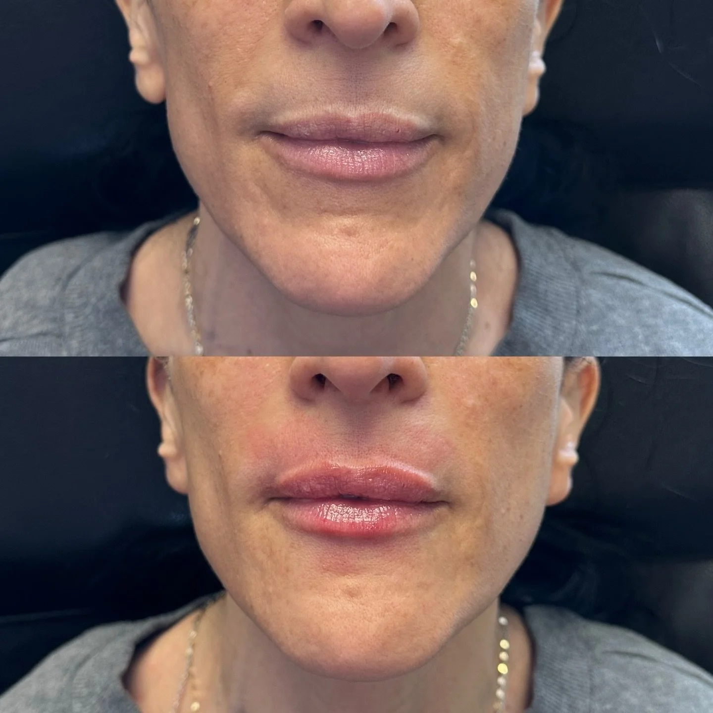 Lifted refresh for my love 

#botox #filler #medsparochester #lipfiller #rochesterny
