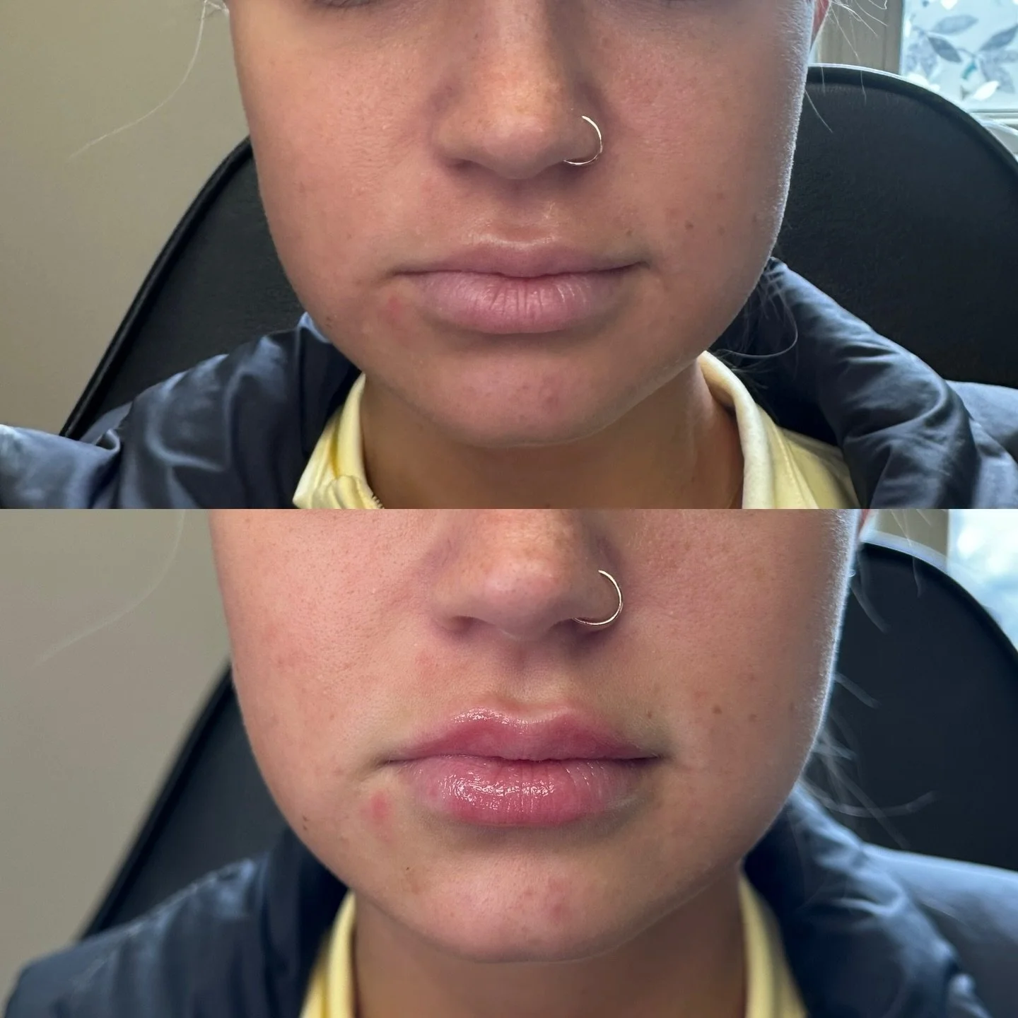 Back to my regular scheduled programming 💋 

#botox #filler #medsparochester #lipfiller #rochesterny