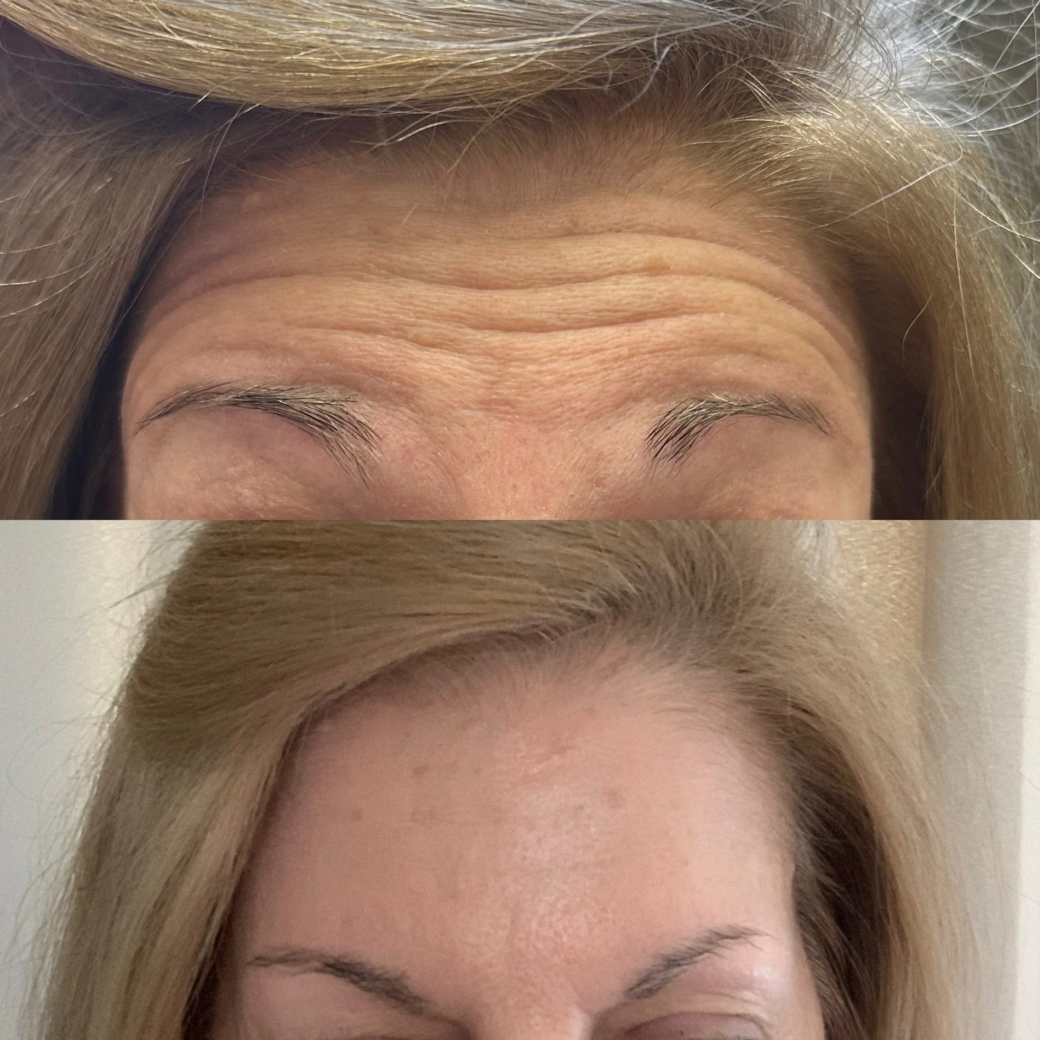 Smooth &amp; glassy the way we like it 

#botox #filler #medsparochester #lipfiller #rochesterny