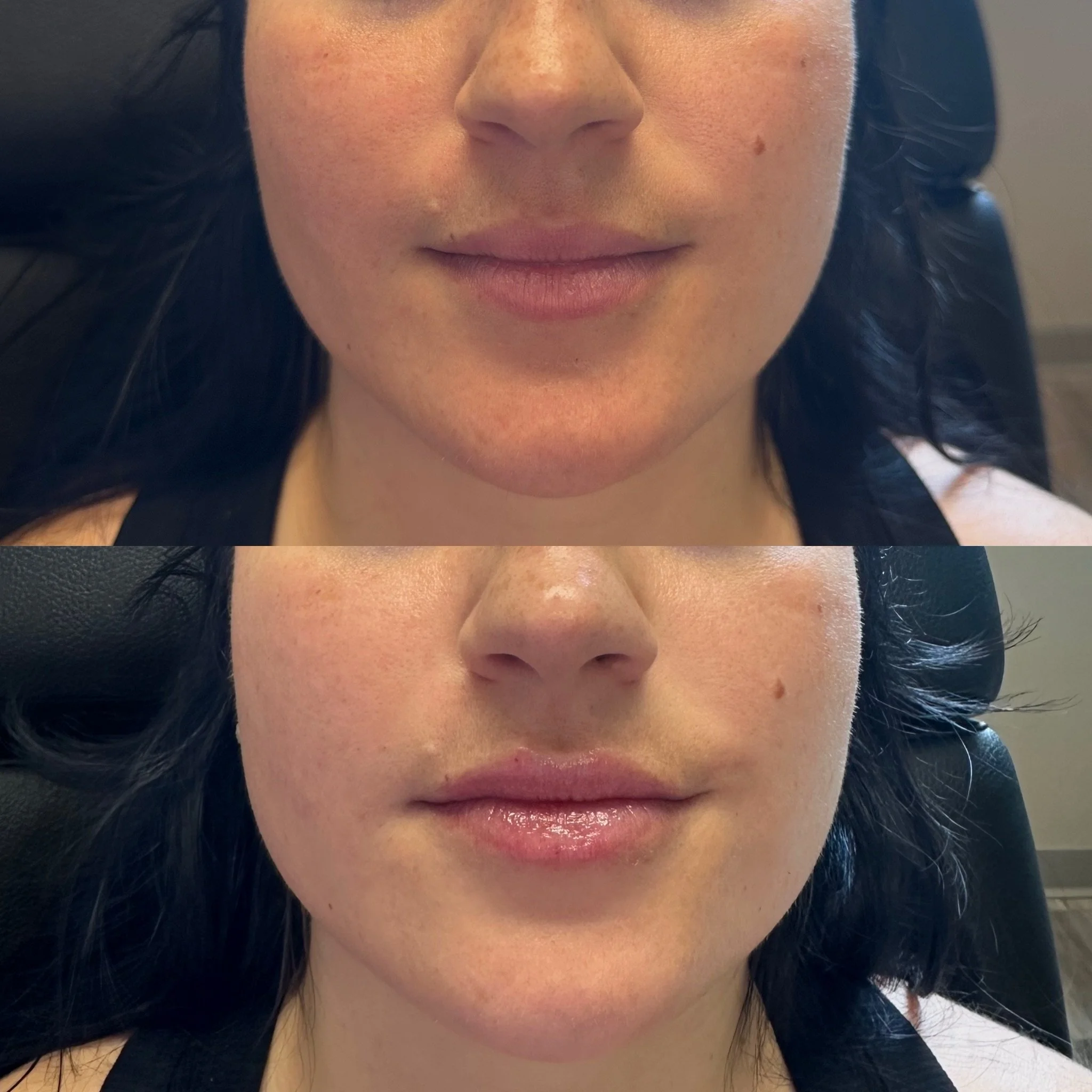 Super cutie refresh for the summer! 

Also side note - is anyone&rsquo;s iPhone camera extremely awful lately?! Wtf 

#botox #filler #medsparochester #lipfiller #rochesterny