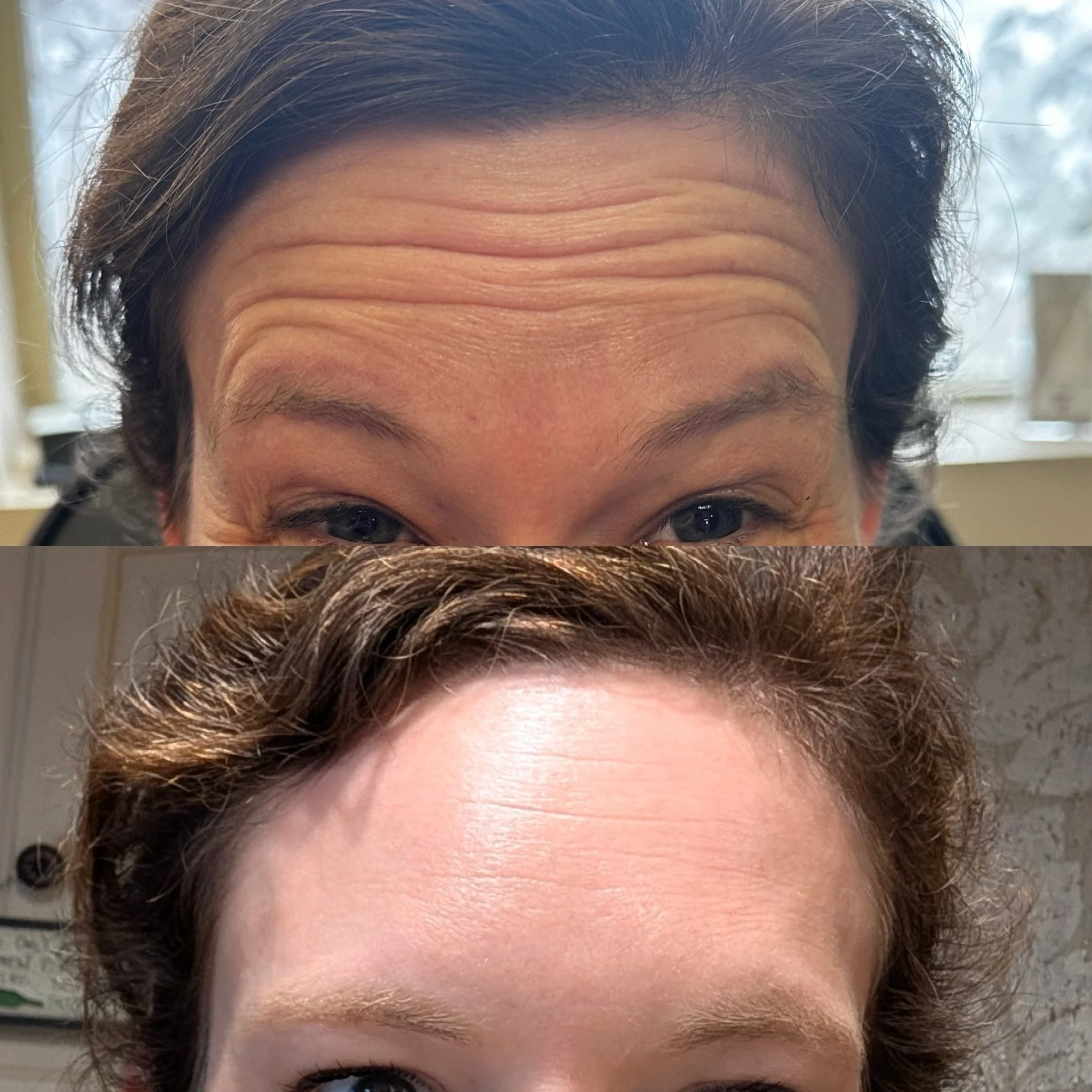 Glassy, smooth, radiant skin brought to you by botox 💉 

#botox #filler #medsparochester #lipfiller #rochesterny
