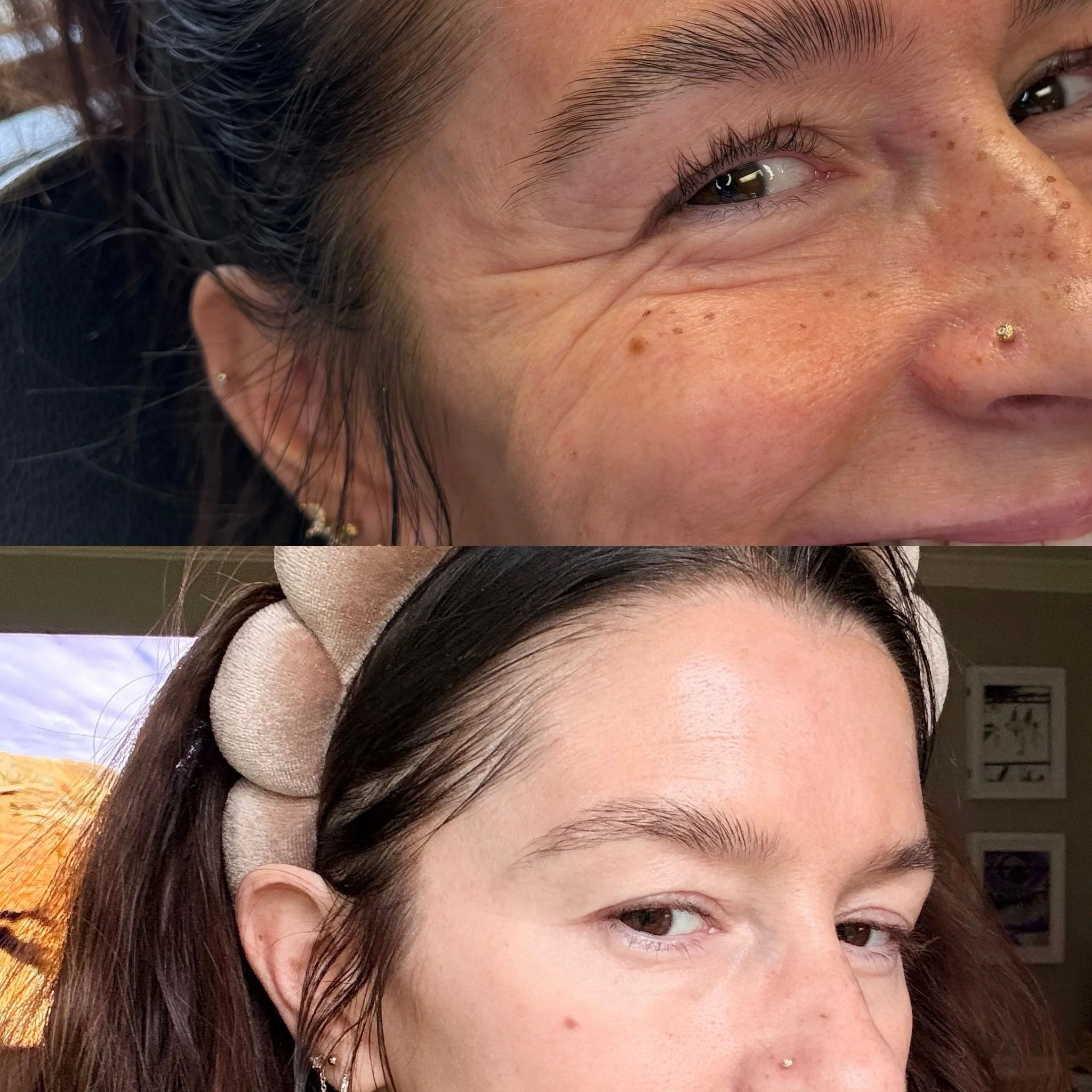 Crows feet are my fav spot to do! They smooth out the area and give you a slight brow lift 

#botox #filler #medsparochester #lipfiller #rochesterny