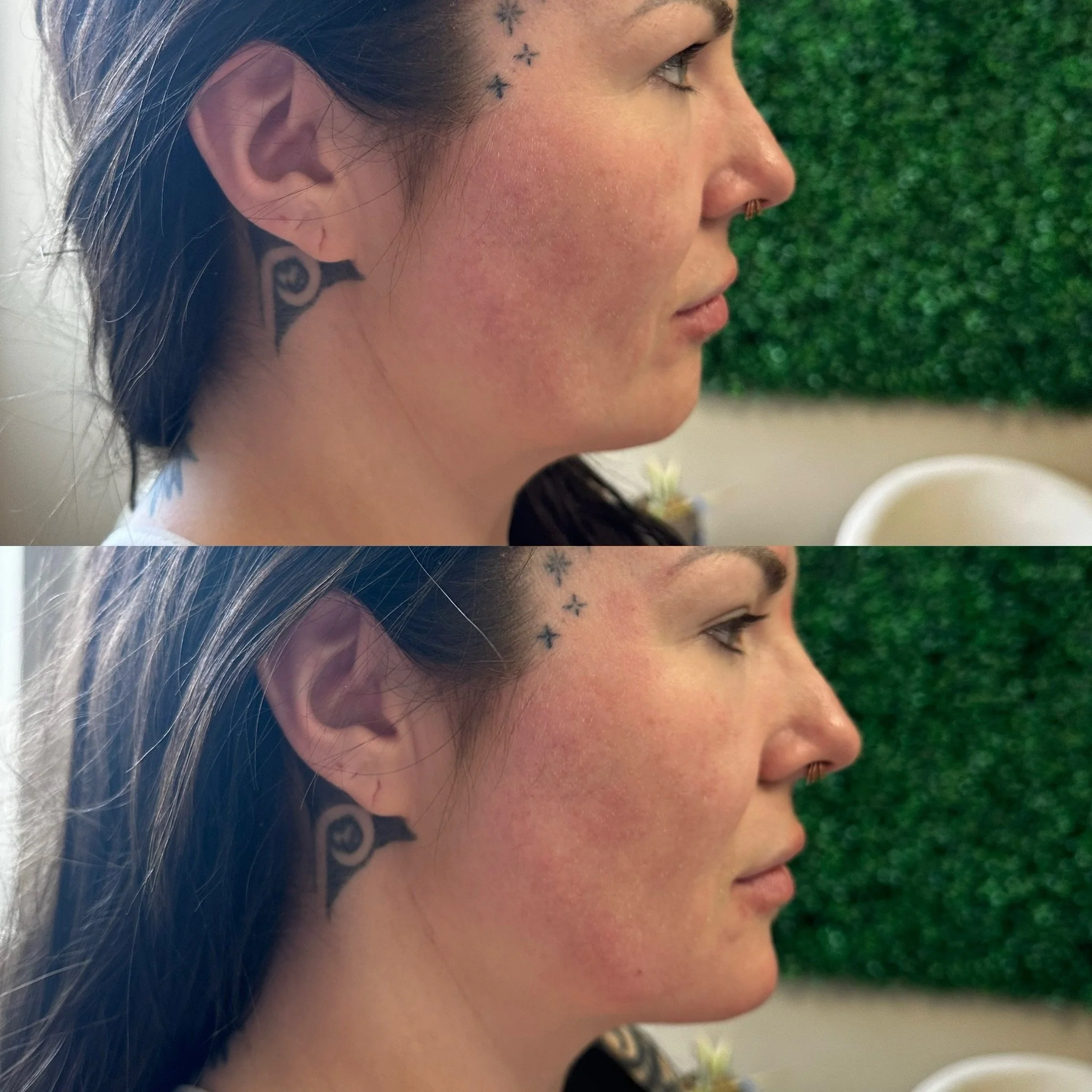 Facial balancing is all about harmony ✨

A strategically placed chin filler treatment can help enhance your profile, improve facial proportions, and create a more balanced, sculpted look &mdash; all while still looking naturally YOU 🤍

Whether you w