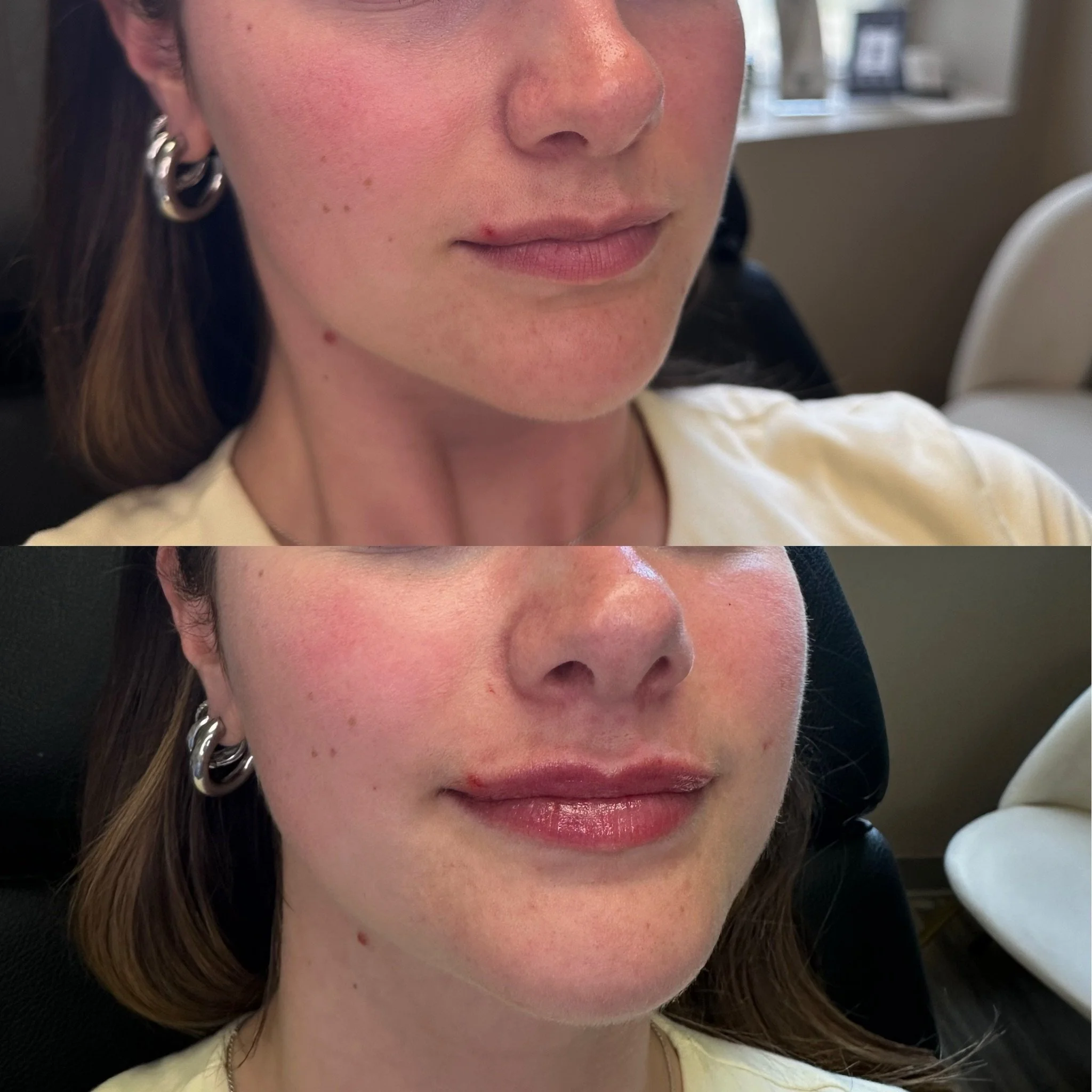 ✨ Plump, hydrated, and beautifully balanced. ✨

Lip filler is one of my favorite treatments because even subtle enhancements can make a huge difference. Whether you&rsquo;re looking for a soft, natural refresh or a fuller pout, every treatment is cus