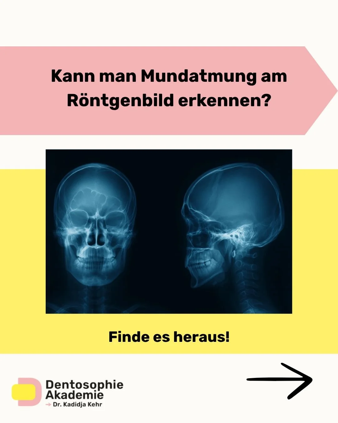Kann man Mundatmung am Röntgenbild erkennen?
Nicht direkt – aber funktionelle Hinweise verraten sie.
Denn chronische Mundatmung hinterlässt Spuren – nicht nur im Gesicht, sondern auch auf dem Fernröntgenseitenbild:
> ei