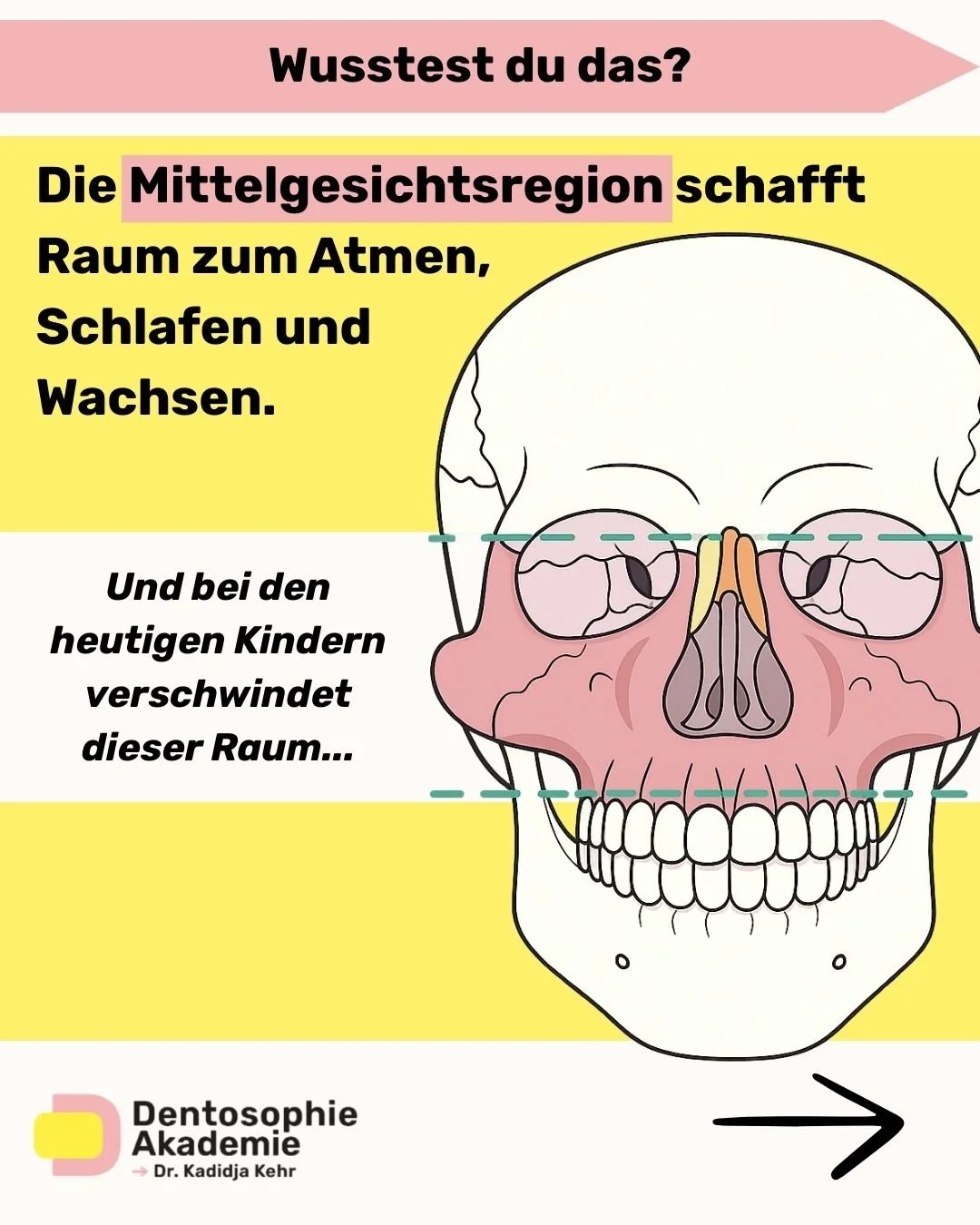 Viele Kinder wachsen heute mit zu wenig Platz im Mittelgesicht auf &ndash; und genau das sehen wir t&auml;glich in der Praxis.
Dunkle Augenringe, Mundatmung, schmaler Oberkiefer, unruhiger Schlaf, Engstand&hellip; all das hat oft denselben Ursprung:
