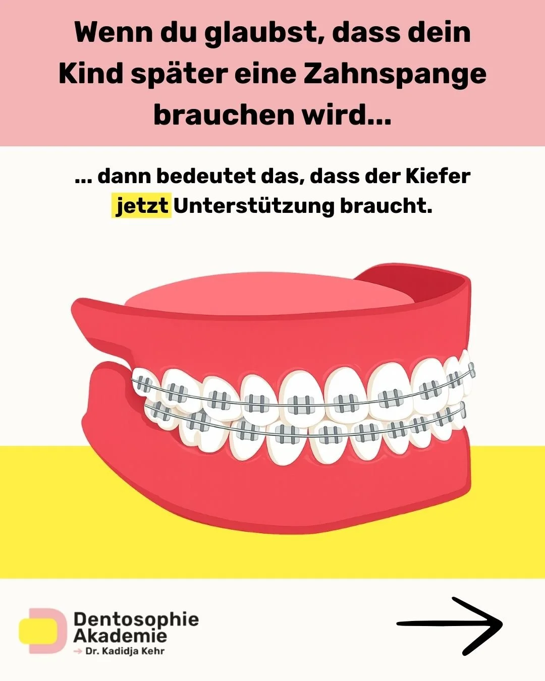 Eltern wird oft gesagt, sie sollen bei Zahnspangen erst einmal &bdquo;abwarten&ldquo;. Eng stehende Z&auml;hne bedeuten jedoch meist, dass der Kiefer eines Kindes nicht breit genug w&auml;chst, damit Z&auml;hne, Zunge und Atemwege ausreichend Platz f