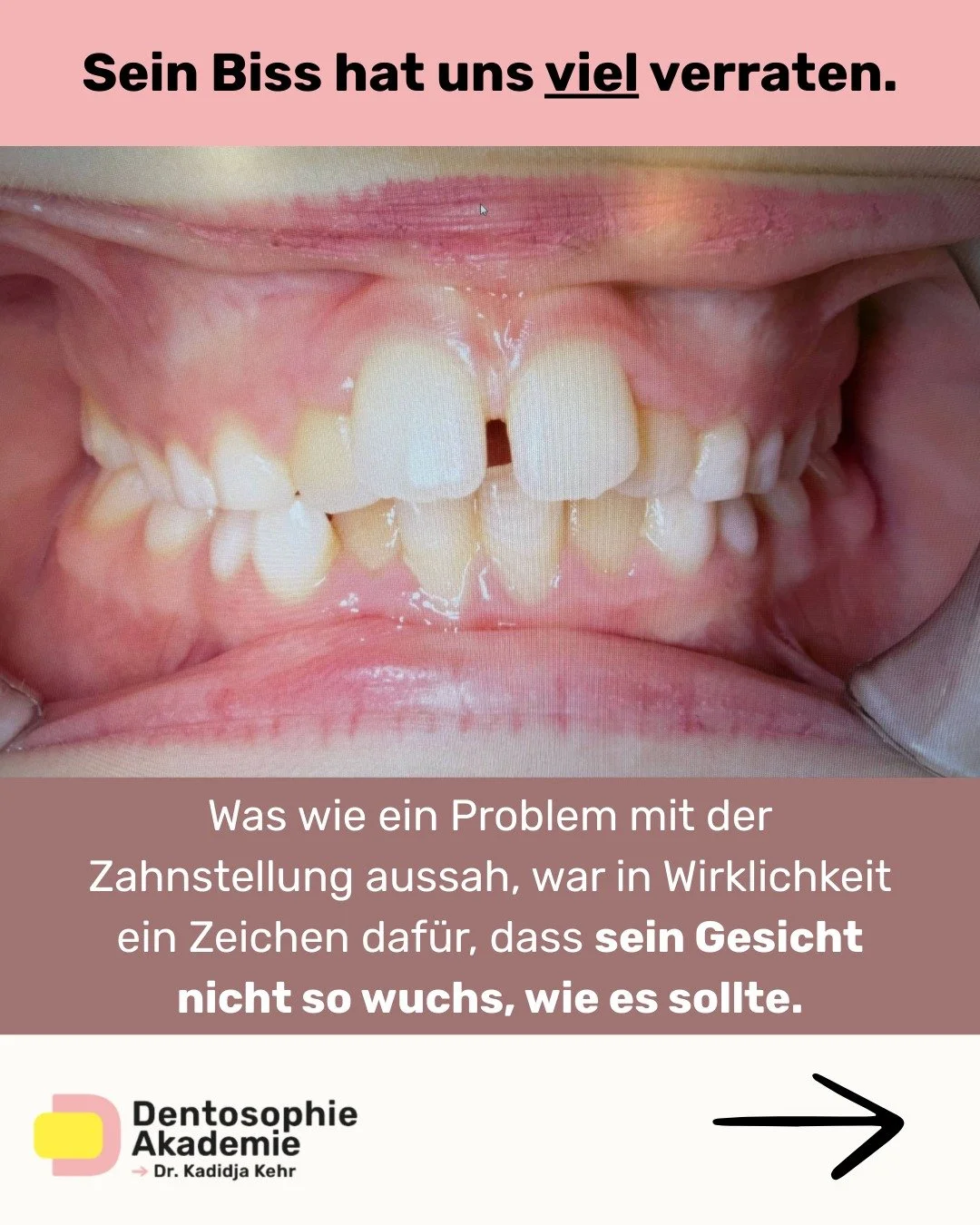 Sein Biss hat uns viel verraten.

Was wie ein tiefer Biss aussah, war mehr als nur ein Zahnstellungsproblem.
Der &Uuml;berbiss zeigte uns: Dieses Kind hatte schmale Zahnb&ouml;gen, eine tiefe Zungenruhelage und einen Kiefer, der sich nicht ausreichen