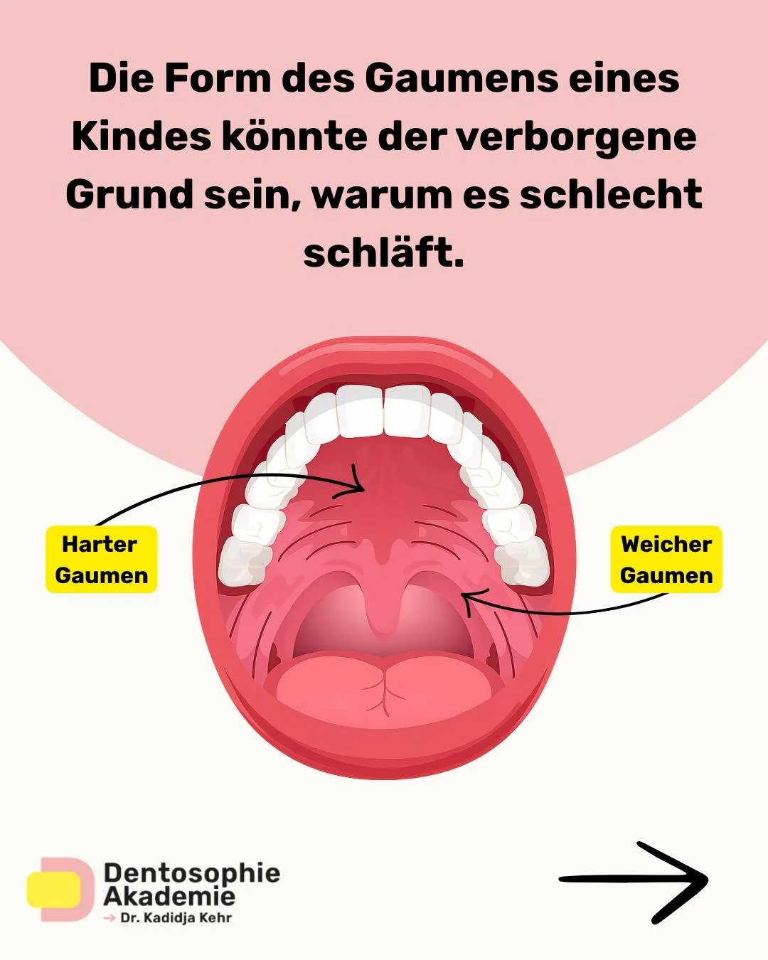 Wenn ein Kind schlecht schl&auml;ft, wird oft zuerst an Routinen oder Verhalten gedacht.

Was viele &uuml;bersehen: die Struktur.

Der Gaumen bildet nicht nur das Dach des Mundes &ndash; sondern auch den Boden der Nase.
Seine Form entscheidet dar&uum