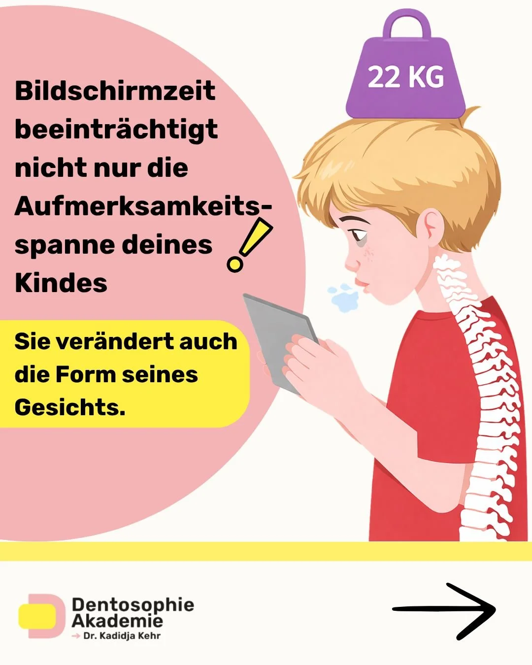 Du hast wahrscheinlich schon geh&ouml;rt, dass zu viel Bildschirmzeit die Aufmerksamkeit und das Verhalten beeinflusst.
Aber wusstest du, dass sie auch beeinflussen kann, wie sich das Gesicht deines Kindes entwickelt?

Wenn ein Kind den Kopf nach vor