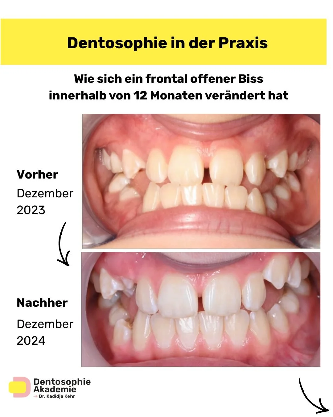 🔎 Viele betrachten bei einem frontal offenen Biss nur die Zahnstellung.
Doch die eigentliche Ursache liegt oft tiefer:

👉 Atmung
👉 Zungenfunktion
👉 Schluckmuster
👉 muskul&auml;re Balance

Dieses Fallbeispiel zeigt, was m&ouml;glich ist, wenn Fun
