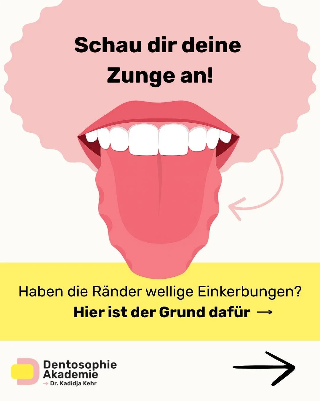 Wenn die R&auml;nder deiner Zunge wellige Abdr&uuml;cke haben, spricht man von einer sogenannten &bdquo;scalloped tongue&ldquo; &ndash; einer gezackten Zunge.

Viele denken sofort: &bdquo;Meine Zunge ist zu gro&szlig;.&ldquo;
Doch meist ist nicht die