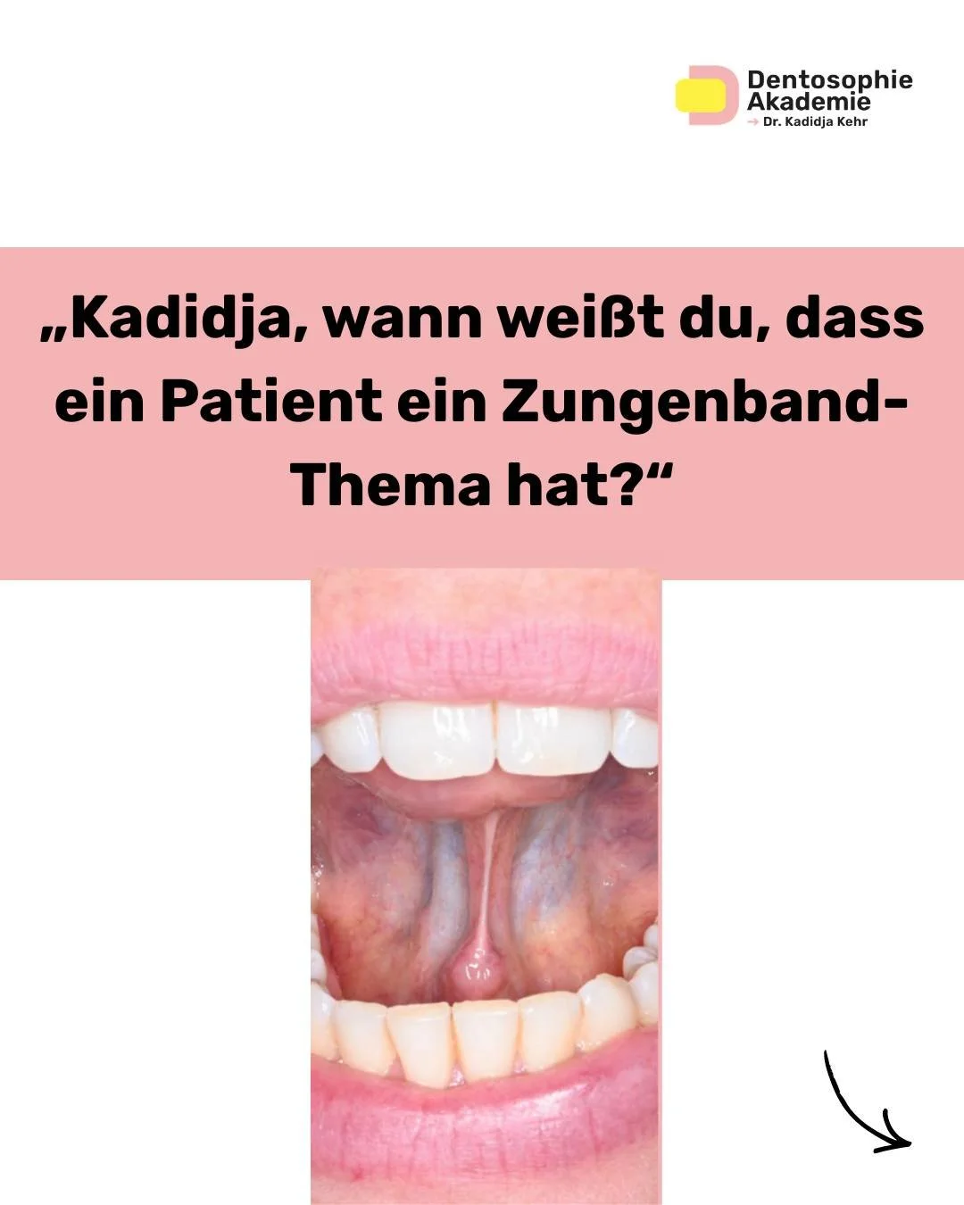 Viele funktionelle Restriktionen erkennt man nicht allein an der Zunge.

Sondern an den Kompensationen, die der K&ouml;rper entwickelt.

&rarr; Bruxismus
&rarr; Mundatmung
&rarr; W&uuml;rgereiz
&rarr; hypertoner Masseter
&rarr; auff&auml;llige Kopfha