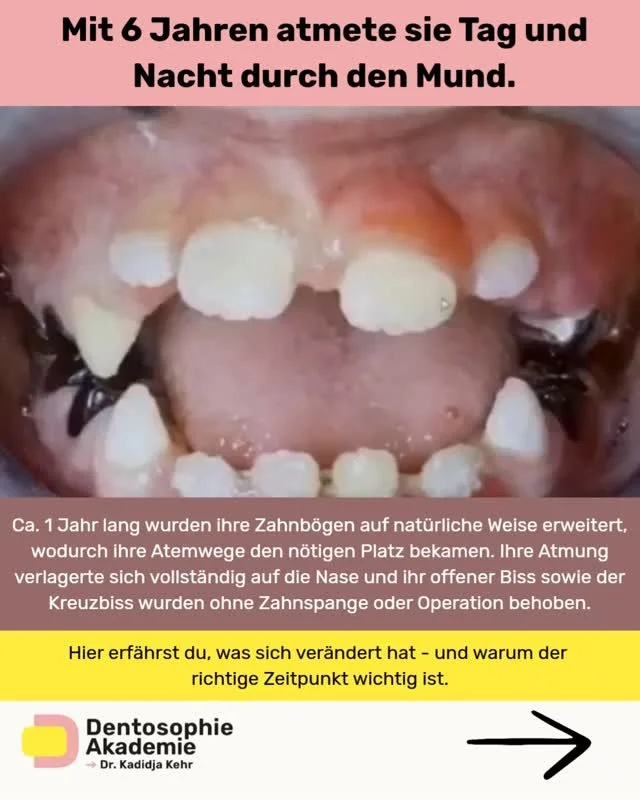 Mit 6 Jahren atmete sie tags&uuml;ber und nachts durch den Mund. Ihre Lippen waren selten geschlossen, ihr Schlaf unruhig und ihre Kiefer hatten nicht genug Platz, sich physiologisch zu entwickeln. Der obere Zahnbogen war schmal, der Unterkiefer unte