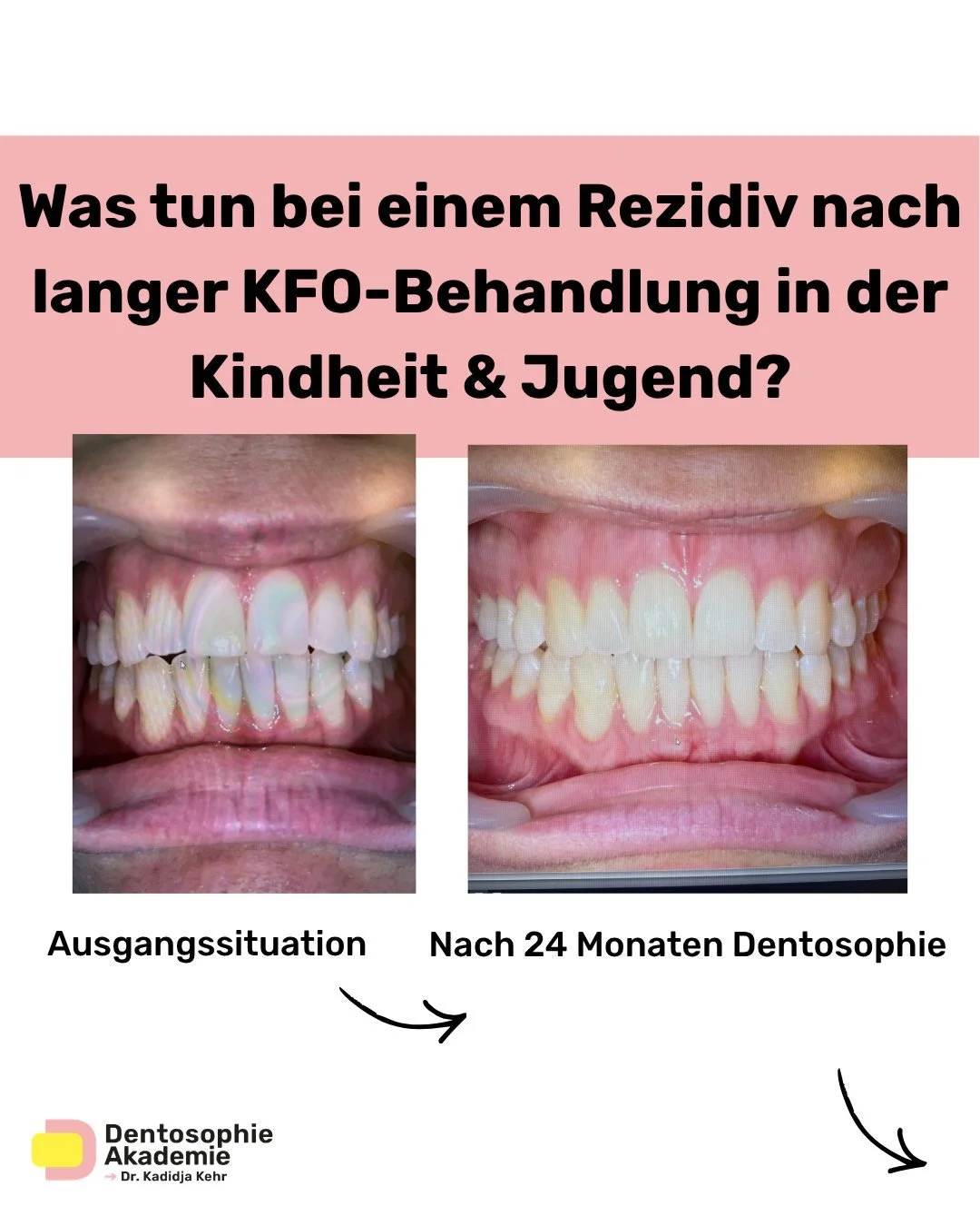 Was tun bei einem Rezidiv nach langer KFO-Behandlung in Kindheit und Jugend?

Dieser Fall hat f&uuml;r mich eine besondere Bedeutung, denn es war mein erster Dentosophie-Fall &uuml;berhaupt 🦷

Die Patientin hatte bereits eine umfassende kieferorthop