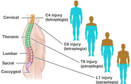 Diagram of spinal cord injury levels showing the cervical, thoracic, lumbar and sacral spine, illustrating the difference between tetraplegia and paraplegia at C4, C6, T6 and L1 injury levels.