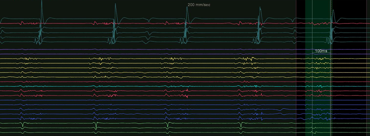 Elektrokardiogramm mit mehreren aufeinanderfolgenden Kurven in unterschiedlichen Farben, die elektrische Herzaktivität darstellen.