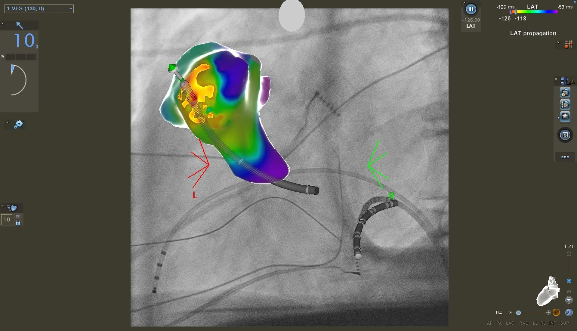 3D Navigation einer VES Extrasystolie