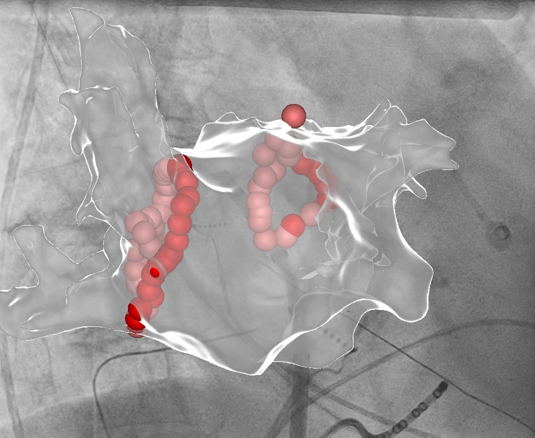 Ein medizinisches Bild, das eine 3D-Darstellung eines Auges mit intravenöser Gehirnangiographie zeigt, inklusive Blutgefäßen und roten Markierungen für den Katheter.