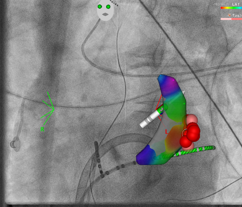 3D Navigation einer akzessorischen Leitungsbahn WPW