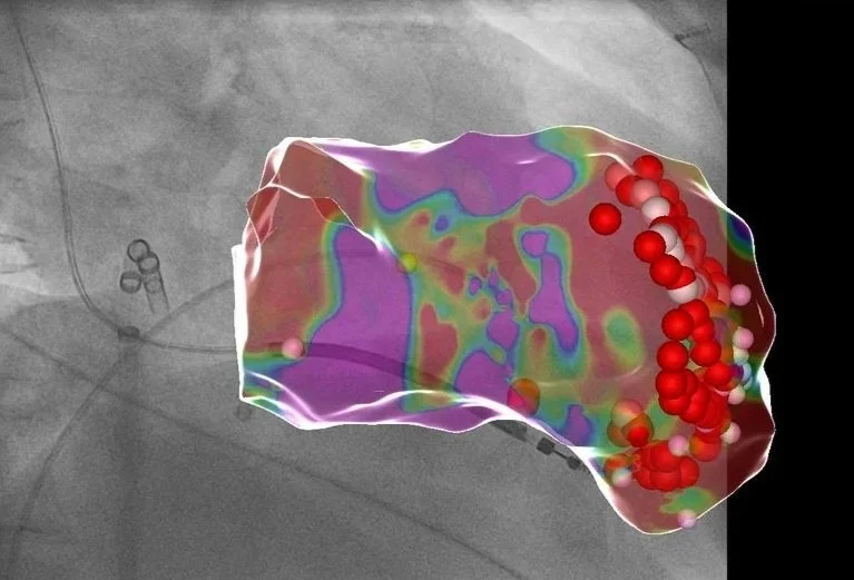 3D Navigation einer VT Ablation