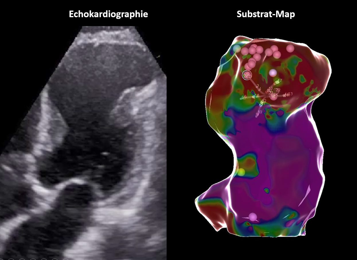 Links ein Echokardiogramm eines Herzens, rechts eine Substrat-Karte mit farbiger Visualisierung und Markierungen.